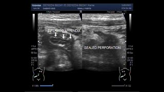 Ruptured Appendix with Sealed Perforation and Mesenteric Lymphadenitis [upl. by Regni]