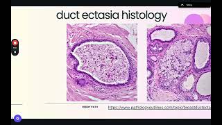 Duct Ectasia Histology Explanation [upl. by Gatias]