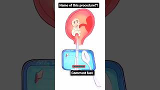 Comment the procedure procedure medical medicalprocedurevideos medicalprocedure medicalstudent [upl. by Rida]