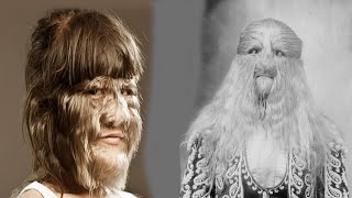 The TERRIFIC History of Hypertrichosis [upl. by Xyla]