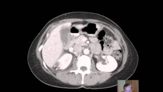 CT Pyelonephritis DISCUSSION [upl. by Ecnadnac]