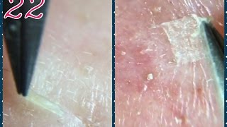 角栓22 皮膚がよく剥けるんです。nose blackheads22 [upl. by Eimak]