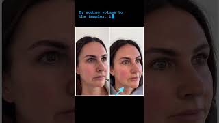 Sculptra The Biostimulatory Injectable for Collagen Production aobmedspa medspa [upl. by Cally]