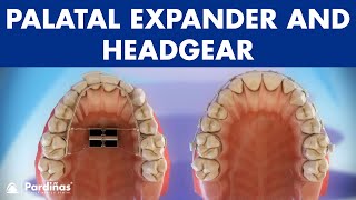 Orthodontic devices  Palatal expander and headgear © [upl. by Ahsratan]