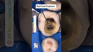 Root Canal Treatment [upl. by Halland325]