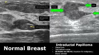 Breast Ultrasound Normal Vs Abnormal Image Appearances Comparison  BIRADS Classification USG [upl. by Maura436]