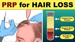 PRP Hair Treatment  prp hair loss treatment before and after  Hair loss Treatment [upl. by Capriola955]