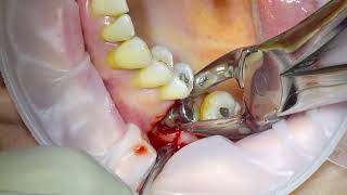 Removal of an Infected Dental Implant [upl. by Glass]