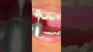 Impacted Canine Braces Treatment  18 Months of Orthodontic Traction  Tooth Time Family Dentistry [upl. by Gnemgnok]