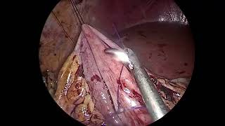 Intracorporeal Anastomosis Laparoscopic complete mesocolic excision right colon Cancer Ali Zedan [upl. by Yehs]