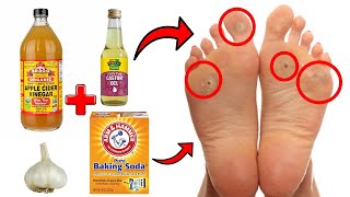 14 Proven Home Remedies For Corns amp Callus Removal THAT WORK [upl. by Doig288]