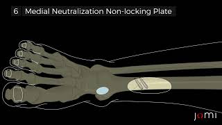 Right Distal Tibial Oblique Fracture Open Reduction and Internal Fixation ORIF Steps [upl. by Aivat]