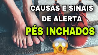 10 Causas de Pernas e Pés inchados e Sinais de ALERTA 🚨 [upl. by Neom]