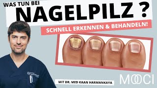 Nagelpilz schnell erkennen amp behandeln Das hilft [upl. by Freya]