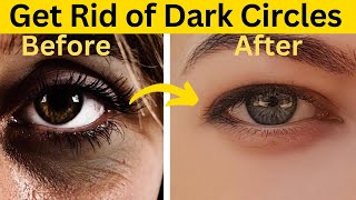 Say Goodbye to Dark Circles Natural Remedies to Get Rid of Under Eyes Dark Circles [upl. by Yrneh]