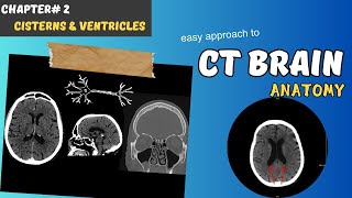 CT BRAIN Chapter 2 Cisterns amp Ventricles [upl. by Ybok484]