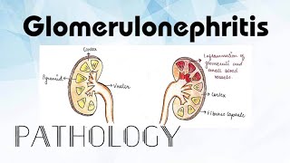 Glomerulonephritis Pathology [upl. by Sherrer]