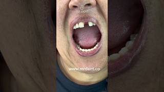 When a tooth falls out this is the best mrdent dentist smile dentalesthetics dentures [upl. by Viviene797]