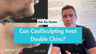 CoolSculpting A NonSurgical Solution for Your Double Chin [upl. by Vershen]