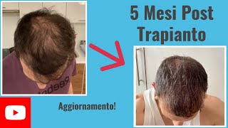 Aggiornamento 5 mesi post trapianto di capelli [upl. by Winny]