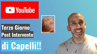 Tre giorni post trapianto Three days post hair transplant [upl. by Brote838]