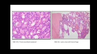 Parotid gland Acinic cell carcinoma [upl. by Kreager905]