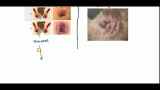 Hemorrhoids Lecture for USMLE [upl. by Lune]