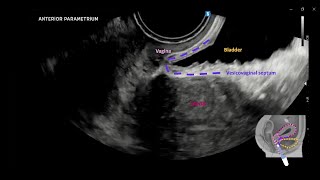 Dynamic transvaginal ultrasound examination for assessing anatomy of parametrium UOGJournal [upl. by Darton]