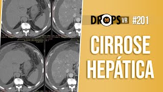 CIRROSE HEPÁTICA  APRENDA A RECONHECER NA TC [upl. by Elwaine]