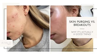 Skin Purging vs Breakouts Whats the Difference [upl. by Ritter]