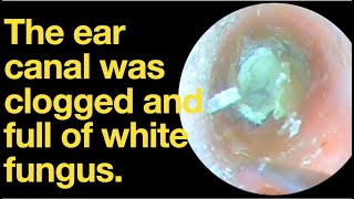 The ear canal was clogged and full of white fungusear wax removal  ear cleaning  ASMR relax [upl. by Esidarap]