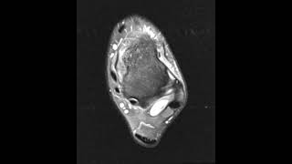 Tibiofibular ligament tear and stress injury of the medial malleolus [upl. by Kneeland]