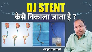 Dj Stent Removal  क्या स्टेंट निकलवाना Painful प्रक्रिया है   Is DJ stent Removal Painful [upl. by Milan252]