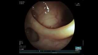 Colonic Diverticulosis [upl. by Sanchez]