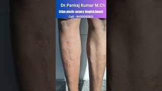 varicose veins treatment with foam Sclerotherapy and Diode laser shorts varicoseveins [upl. by Doownyl]