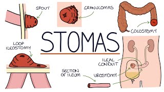 Understanding Stomas Colostomy Ileostomy Urostomy and Gastrostomy [upl. by Aneeuqahs]