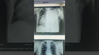 Normal VS massive pleural effusion x ray doctors viralvideo viralreels viralshort viralsong [upl. by Cirded369]