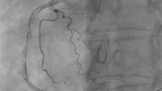 Thrombus aspiration  right coronary artery [upl. by Netsrejk]