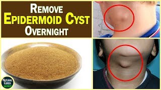 How To Remove Epidermoid Cyst Overnight  Epidermoid Cyst Removal At Home [upl. by Suolkcin583]