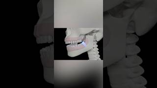 Wisdom Tooth Inflammation dentistteeth dentist oralhealth [upl. by Anais]