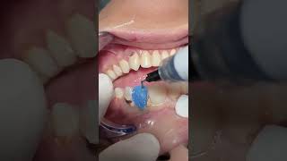 Deep caries with Composite veneer dentist [upl. by Whiney]