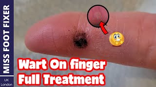 wart on finger full Treatment  after Treatment Updates Too By Miss Foot Fixer [upl. by Anelrahs]