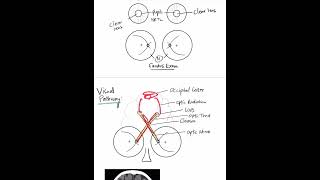 Cortical Blindness  Case Discussion In A Minute Shorts [upl. by Calloway578]