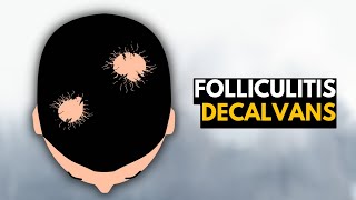 Folliculitis Decalvans What You Need To Know [upl. by Gittel]