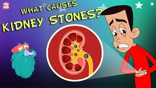 What Causes Kidney Stones  The Dr Binocs Show  Best Learning Videos For Kids  Peekaboo Kidz [upl. by Angelique]