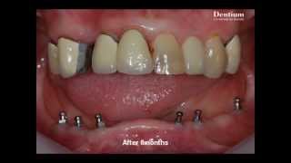 Miniimplant supported amp retained denture [upl. by Asserat]