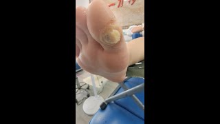 Large plantar wart under the toe 【FanYi】 [upl. by Gemoets]