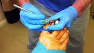 Chiropodist and Podiatrist in Norwich  Nail Surgery [upl. by Charlotte720]