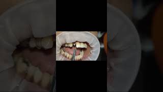 Upper lateral incisor compressive bioline implant tapping test after 6 months shorts [upl. by Yelknirb]