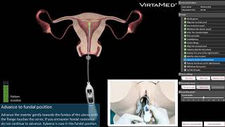 VirtaMed GynoS™ IUD Placement Simulator [upl. by Genesia]